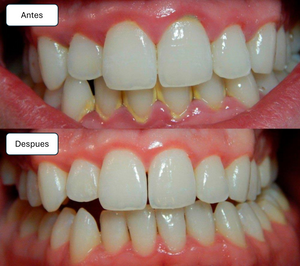 Cepillo Eléctrico Dental Ultrasónico